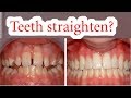 How Long Do Braces Take To Straighten Your Teeth How Long Do Braces Take To Straighten Your Teeth