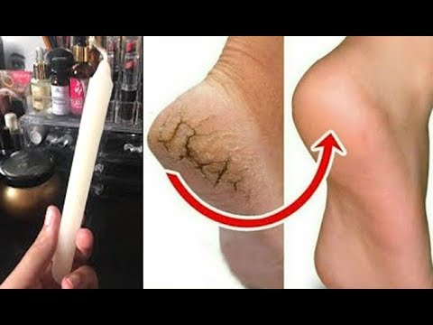 In Just 5 Minutes Get Rid of CRACKED HEELS Permanently, best treatment for dry cracked heels Remedy