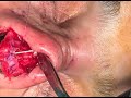 Op dr abdullah ahmed open rhinoplasty   ak rinoplasti 