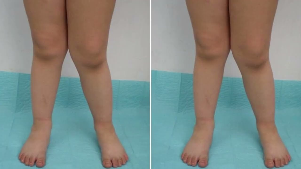 வளைந்த முட்டுக்கு தீர்வு | Easy exercise to get rid of bow knees #drraja #royalmulticare #bowknees