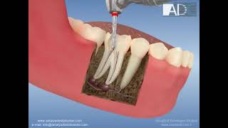 طريقة علاج عصب الأسنان والتخلص من الألم 3d