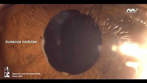 see clearly floating precipitates in the cells of the anterior chamber