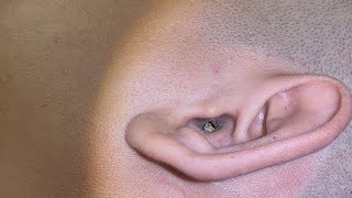 Massive Earwax Plug Removal Blocked Hearing For 7 Days