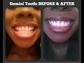 Gemini Teeth Whitening Accelerator HOME Edition | LIVE DEMO and Review