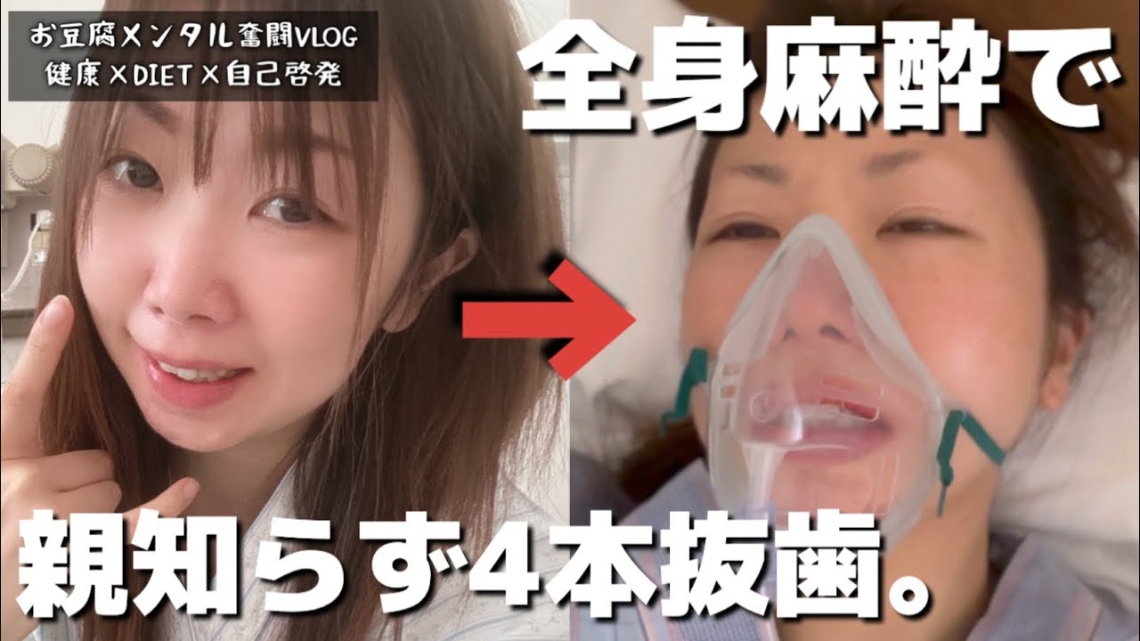 【親知らず4本同時抜歯】全身麻酔手術から1ヶ月後までの経過を全て見せます。