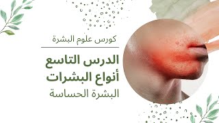 كورس علوم البشرة | الدرس التاسع | البشرة الحساسة أنواعها و طرق العناية الخاصة بها