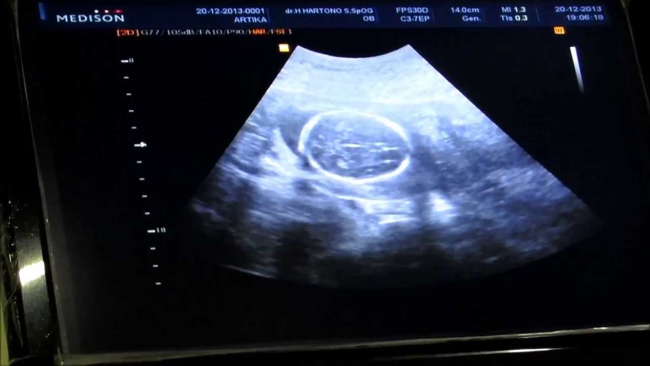 usg kehamilan 20 minggu 20 desember 2013 fetal usg kehamilan 20 minggu 20 desember 2013 fetal