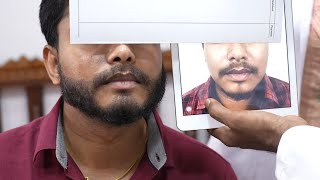 Beard Transplant Surgery Before and After - Beard Transplant 5 Month Amazing Result