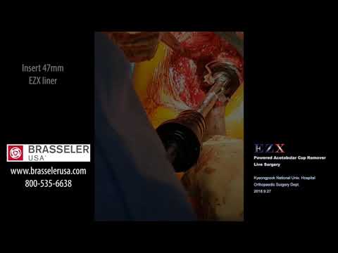 Brasseler EZX Acetabular Cup Removal System Live Video