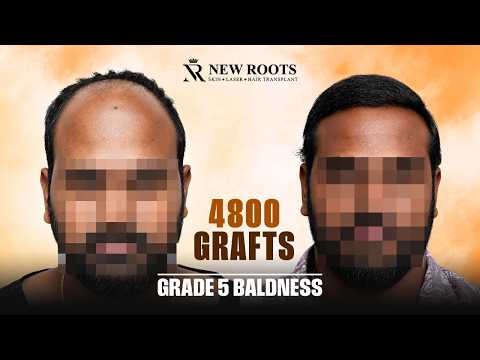 This Hair Transformation 🔥 | 4800 Grafts | Grade 5 Baldness | Hyderabad | Cost & Best Results
