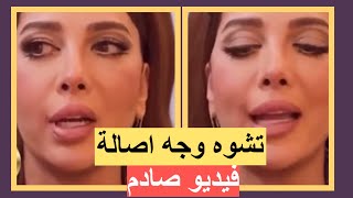 تشوه وجه اصالة نصري بعد عملية التجميل في نيويورك ‼️