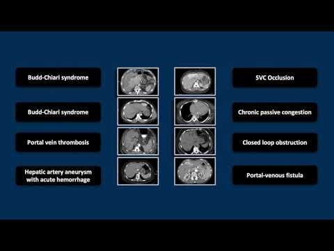 Hepatic Vascular Emergencies | Interesting Radiology Cases