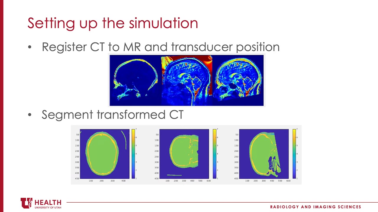Slominski - Simulations of Phase Correction Methods in Transcranial MRgFUS (Poster) (2020)