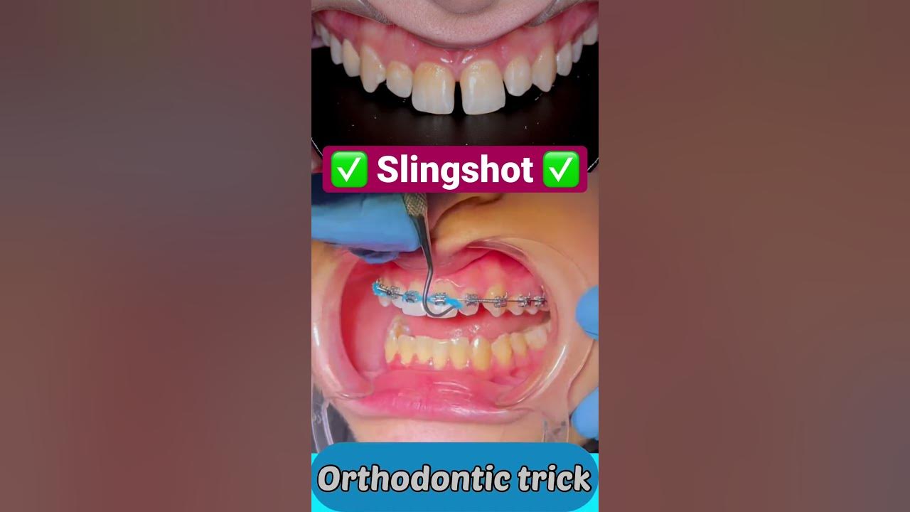 سد فراغات الاسنان الأمامية Power chain Slingshot Orthodontic trick