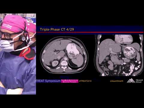 Transradial Radioembolization of HCC with Therasphere Y-90