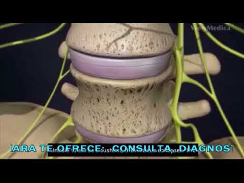 Hernia de disco, síntomas y tratamiento Dr. Cary H. Rothenberg saludos amigos dvd