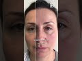 Ptosis de la paupière : causes et solutions | Dr Hayot Paris