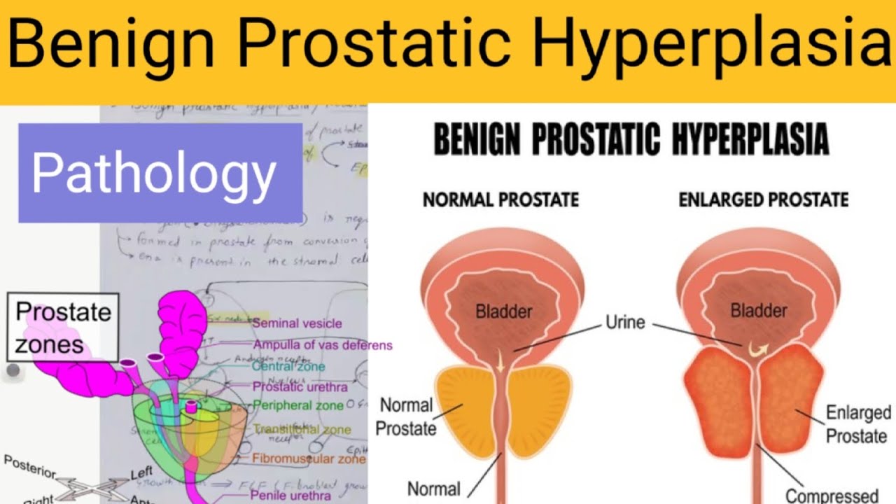 Benign Prostatic Hyperplasia Vs Prostate Cancer Benign prostatic hyperplasia Pathology | SAQ | - YouTube