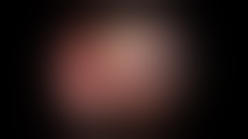 Laparoscopic Cholecystectomy by Dr Hitesh Chavda