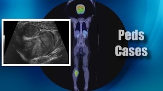 Cases - Soft Tissue - Lower extremity Undifferentiated Sarcoma screenshot 4