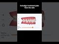 Invisalign Treatment Plan from Side Angle