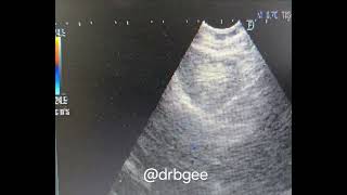 EBUS- transbronchial cryo‐nodal biopsy