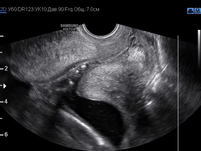 Матка 25 мм. Внутренний зев при беременности УЗИ. Шейка матки цервикометрия.
