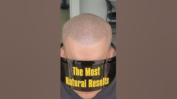 Scalp Micropigmentation
