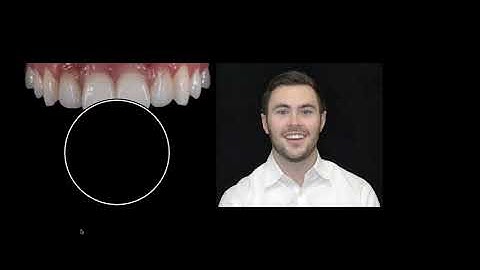 The Incisal Edge  A Dynamic Microcosm of Optical Properties with Peter Pizzi, CDT, MDT