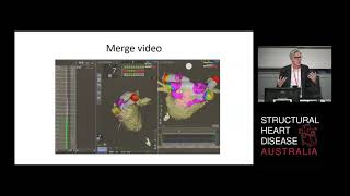 Where are we at with 3D Mapping: Electroanatomic Mapping - A/Prof Stuart Thomas