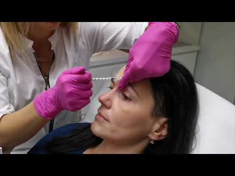 Videó: Lehajló Szemhéj Botox Után: Okai és Kezelése