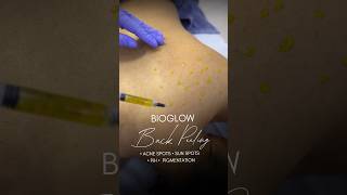 Peeling For Back Pigmentation And Acne Spots