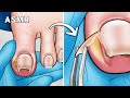 ASMR Oddly Satisfying Ingrown Toenail Removal Foot Care Animation ASMR Oddly Satisfying Ingrown Toenail Removal Foot Care Animation