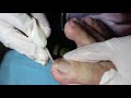 Ep_3036 Toenail removal 👣 พี่ดูชิ้นนี้ซิ 😷 (This clip is from Thailand)