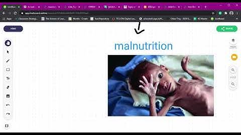 Components of Food (Part 8)- Obesity, Malnutrition and Deficiency (CBSE Grade 6)
