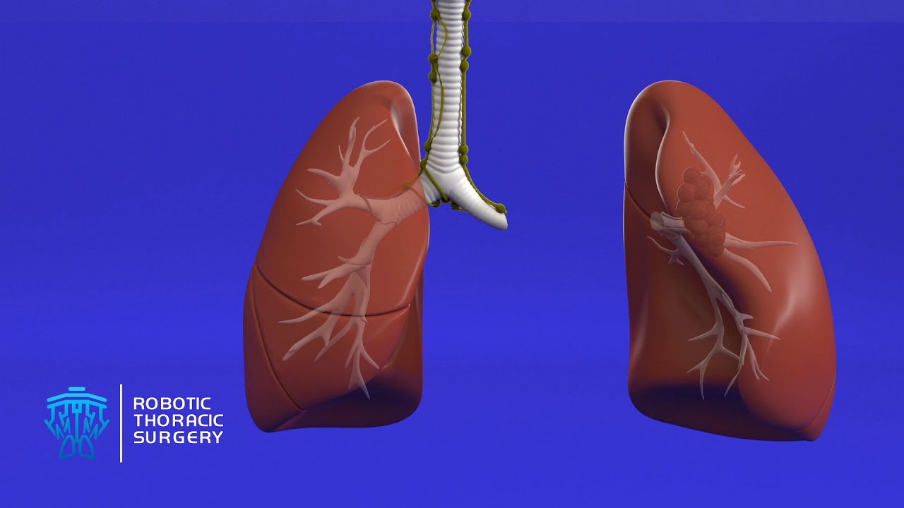 What Do I Need To Know About Lung Resection YouTube What Do I Need To Know About Lung Resection YouTube