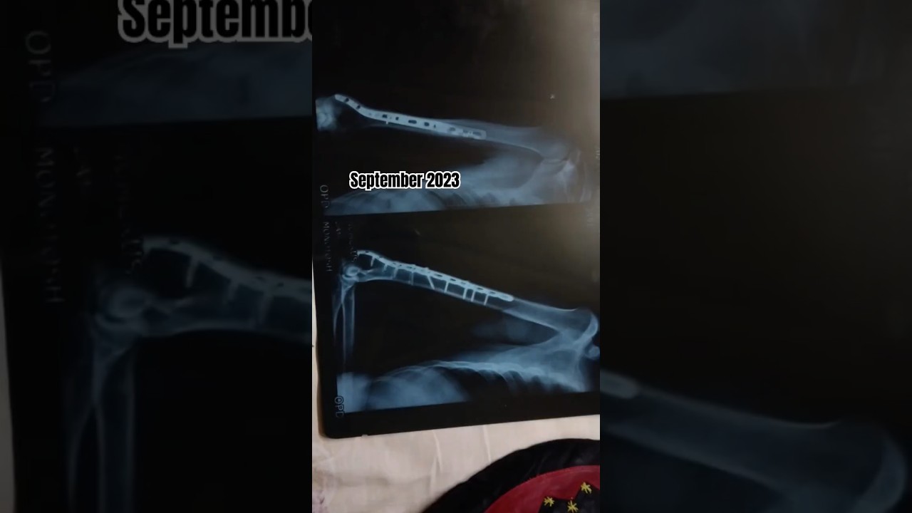 Heal with time... Humerus fracture recovery after orif surgery