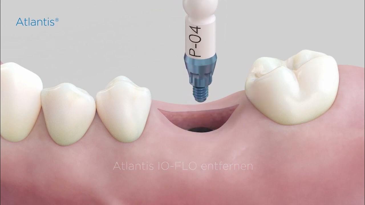 Dentsply Sirona Atlantis Healing Abutment von der Implantation bis