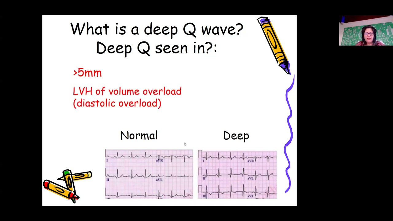ECG in chamber enlargement by Dr Sunita Maheswari