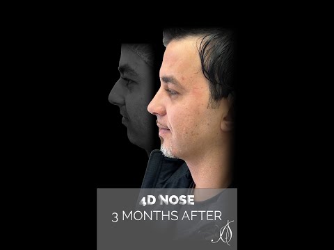 Video thumbnail: 4D Nose Approach- 3 Months After · Dr. Anil Shah