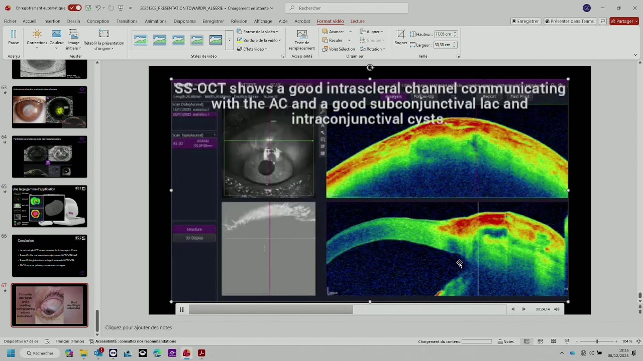 TowardPi La revolution de l'OCT/OCTA Ultra Wide Field