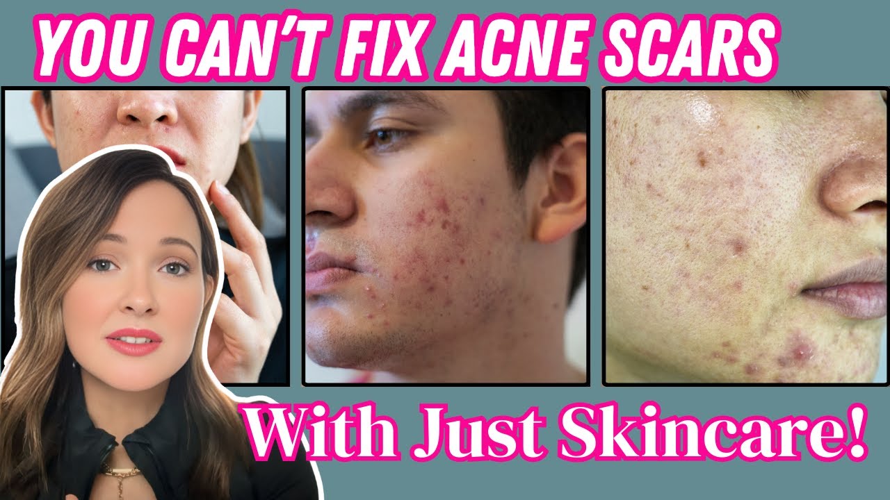 Ask a Dermatologist  Top Questions on Acne Scarring Answered