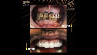 اسباب تسوس الاسنان و طرق علاج تسوس الاسنان