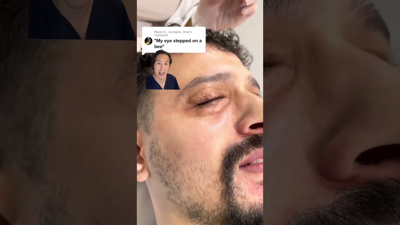 What is Carboxytherapy and Should You Do It?