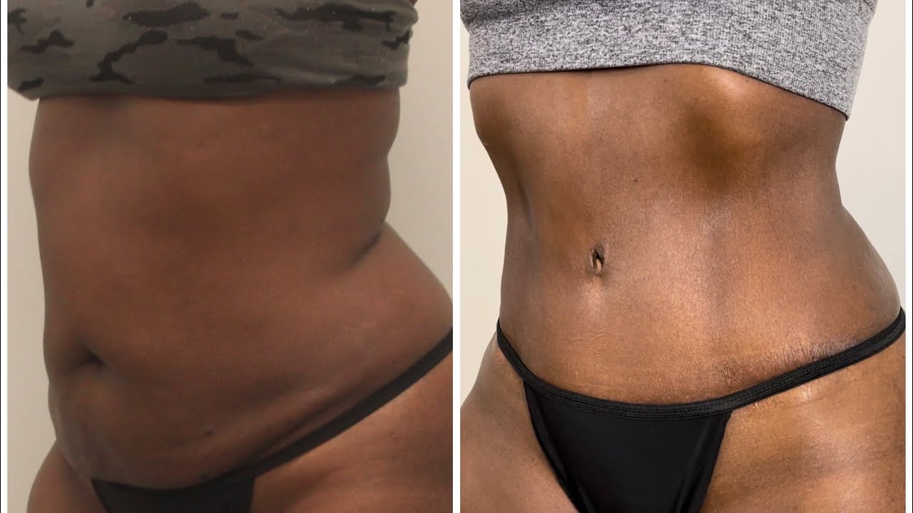 Why Choose Dr. Ravi For a SMART Tummy Tuck?