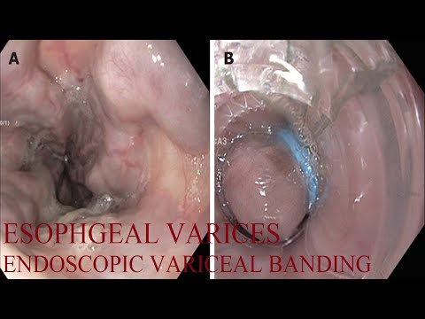 Esophageal varices| Endoscopic banding| Cirrhosis of liver| Portal hypertension| Dr. Pandiaraja