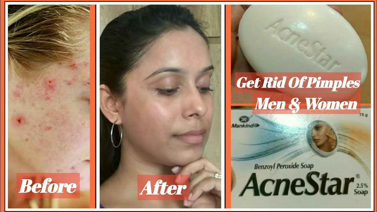 Acnestar Soap Full Review मुहांसो से कैसे पाए छुटकारा How to