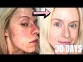 In 30 days I fixed 15 years of horrible red bumpy dry pimple- filled skin *LIFE CHANGING*