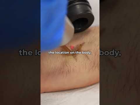 Laser Tattoo Removal Sessions | #tattooremoval #tattooremovallaser #clinic