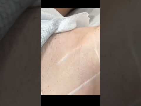 طريقة حقن البوتوكس لعلاج فرط التعرق تحت الابط  اكسبلور بوتوكس  تجميل  ترند